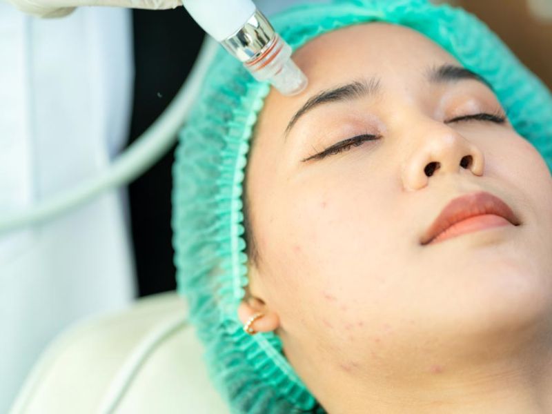 Laser Skin Treatment
